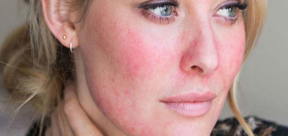 干燥与敏感肌护理