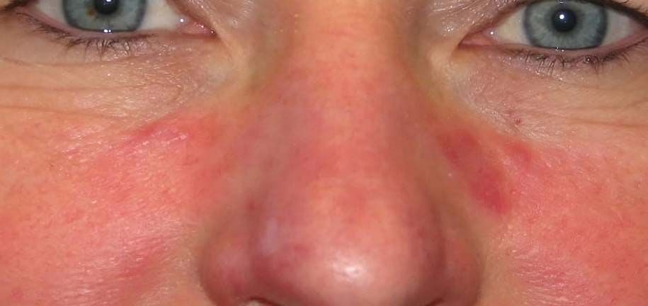 脂溢性皮肤护理